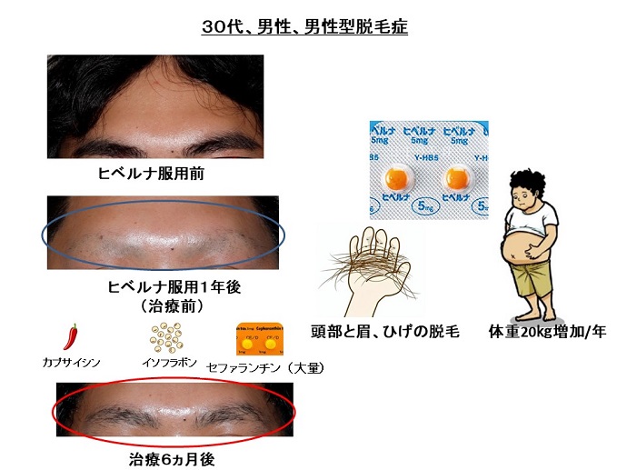 円形脱毛症　病院